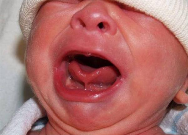 دلیل و درمان چسبندگی زبان به کف دهان در نوزادان