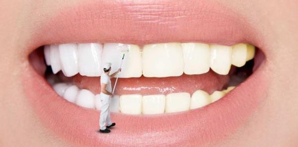 جرم گیری دندان چیست؟ انواع جرم گیری در مطب،روش های جرم گیری در منزل